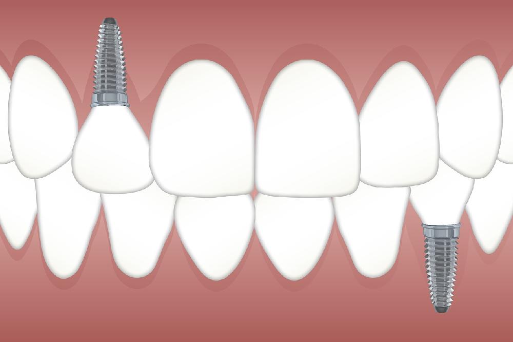 Implanty stomatologiczne - co warto o nich wiedzieć?